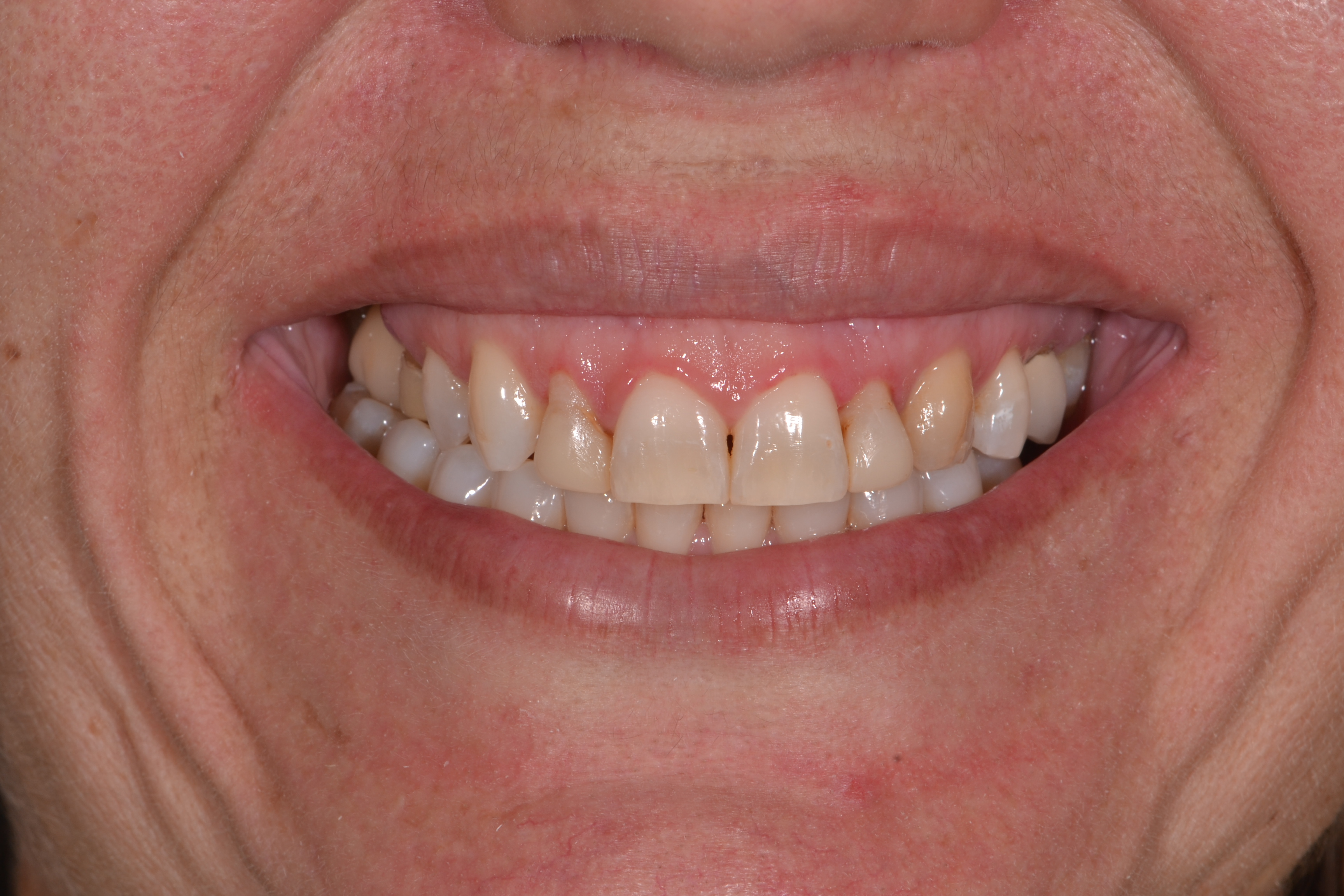 Antes - Facetas dentárias