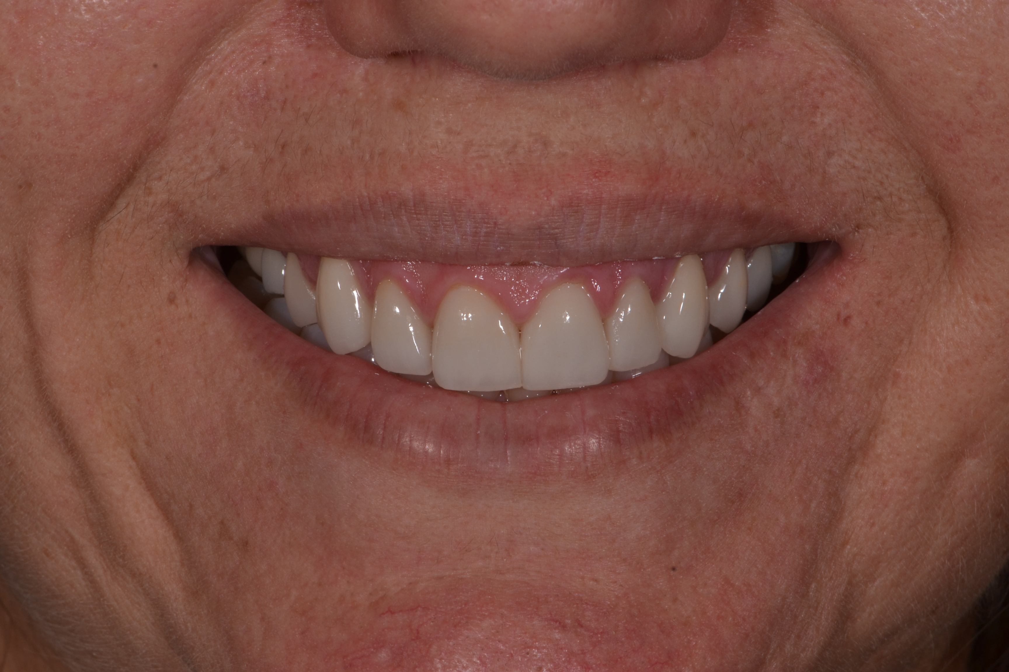 Depois - Facetas dentárias