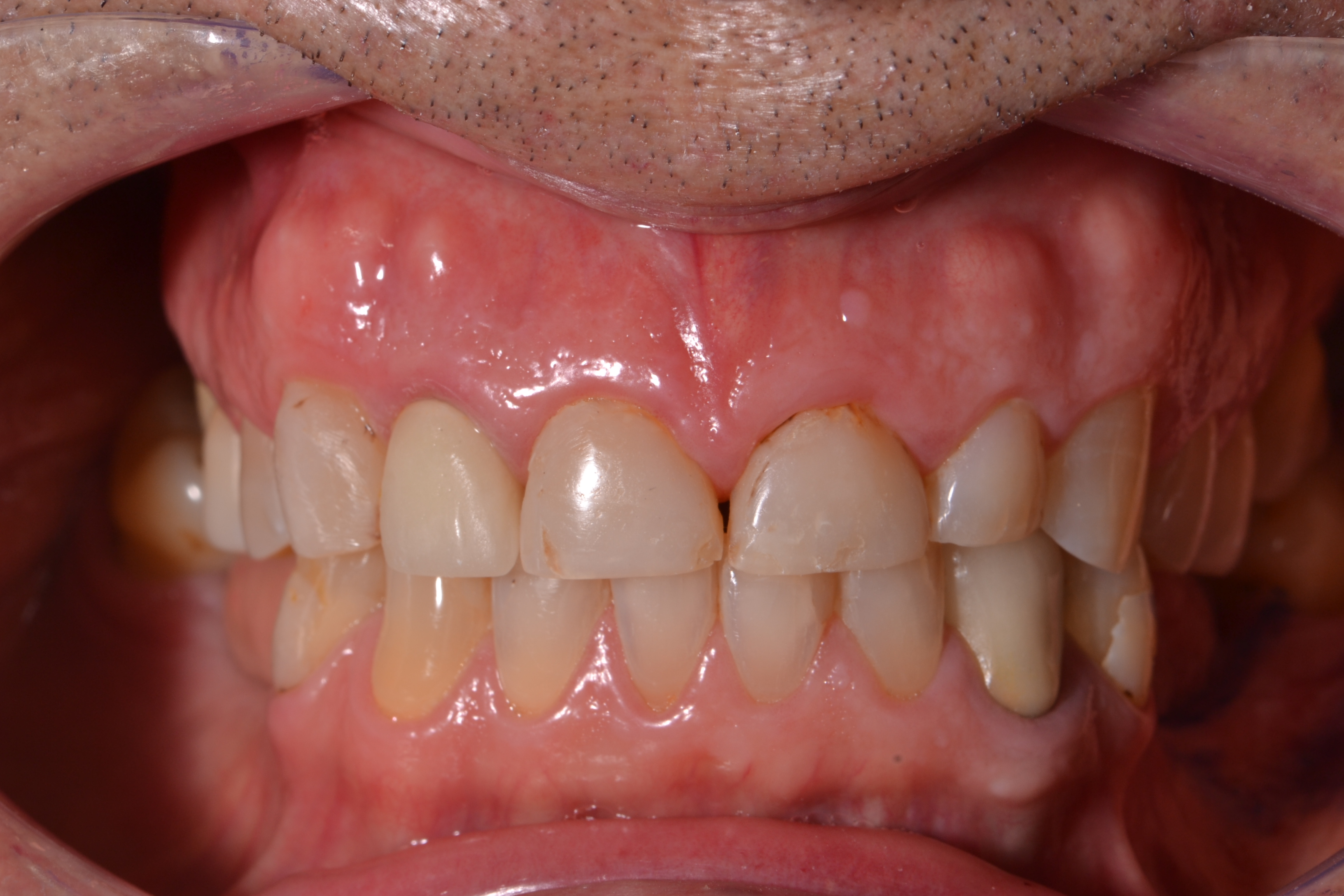 Antes - Facetas dentárias caso 2