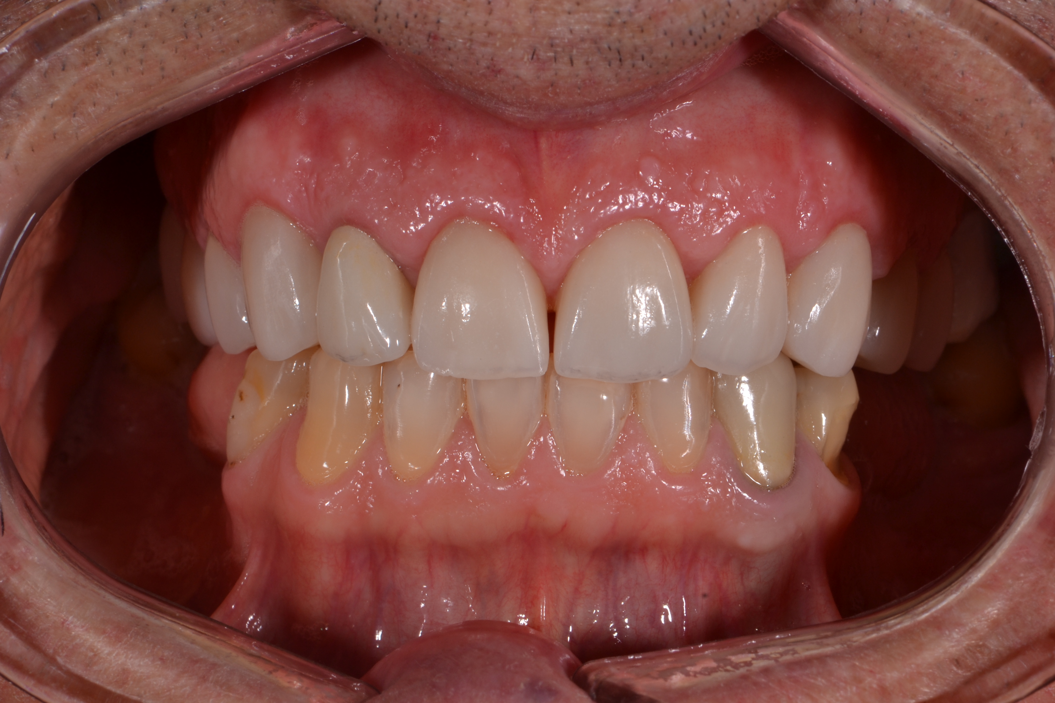 Depois - Facetas dentárias caso 2