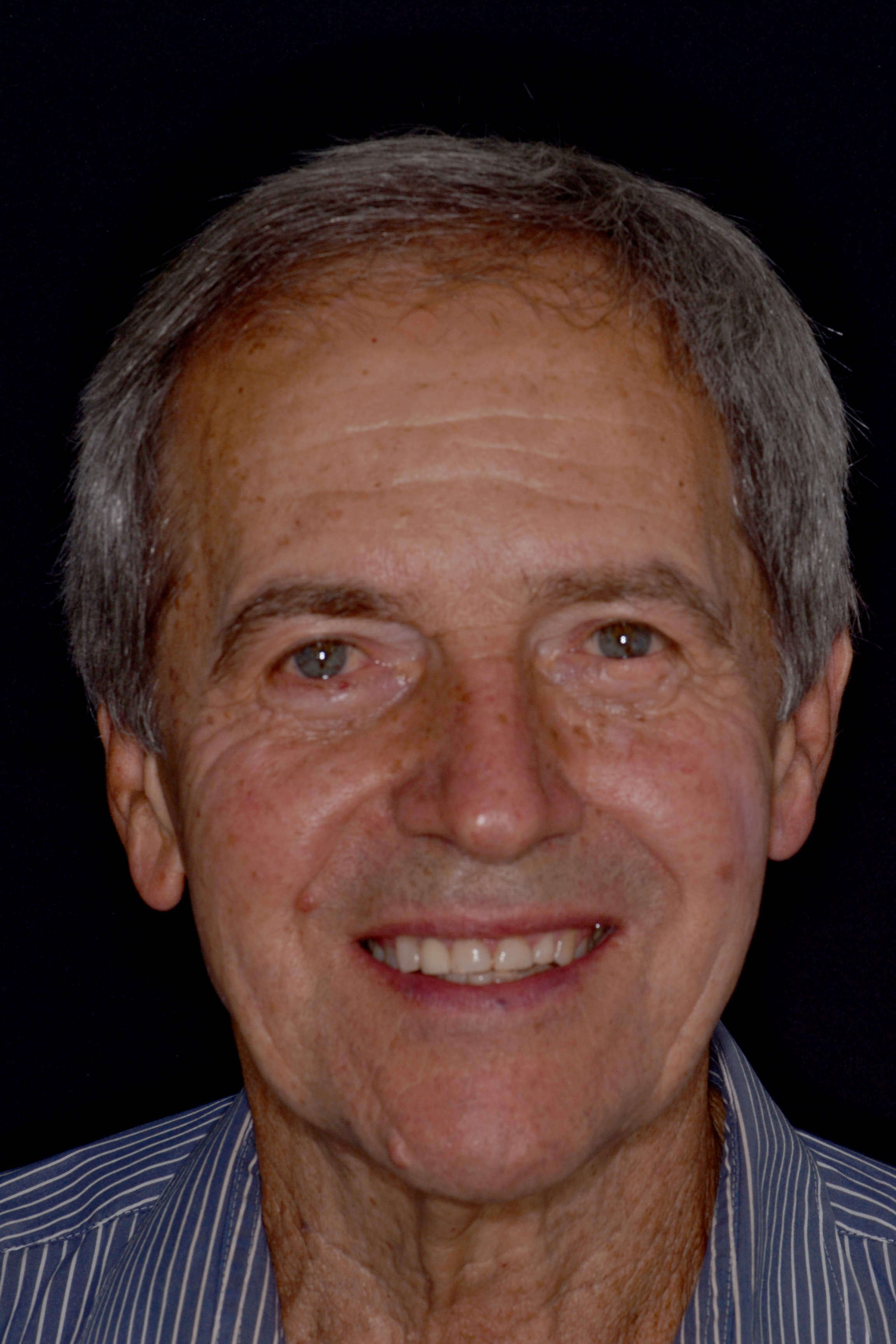 Antes - Facetas dentárias caso 3