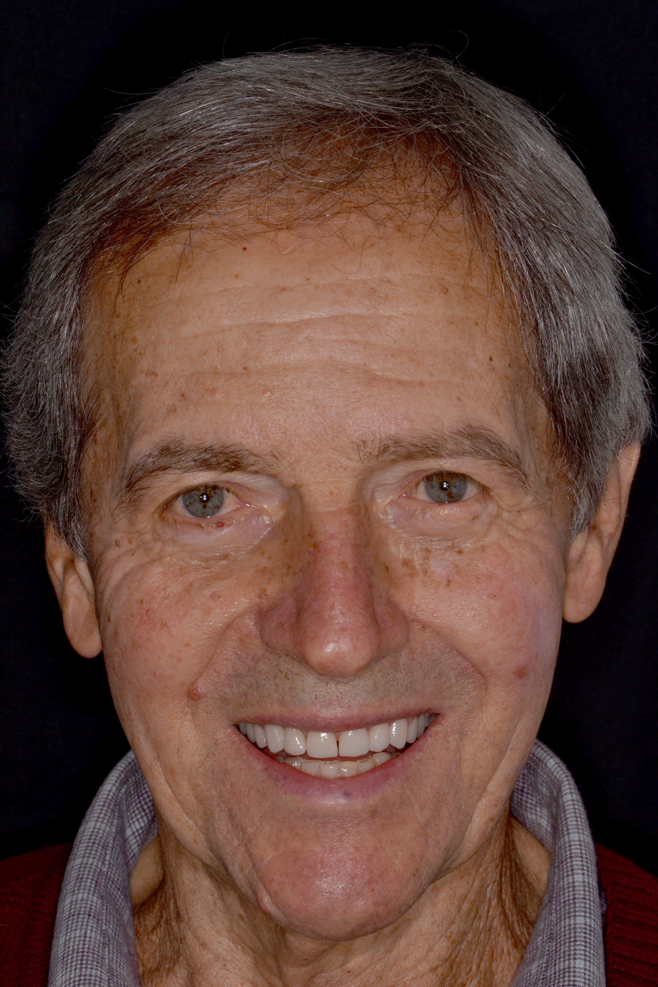 Depois - Facetas dentárias caso 3