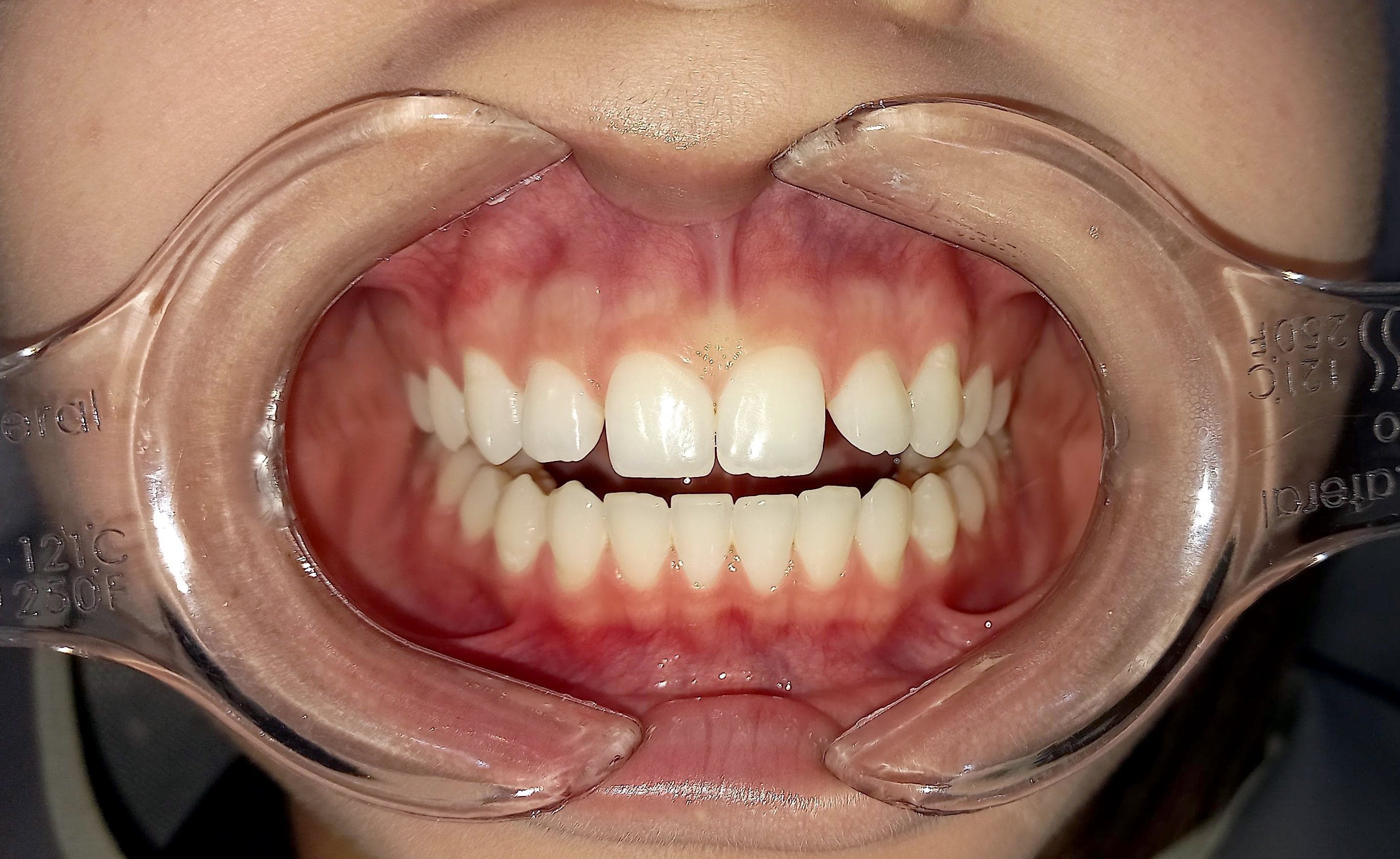 Antes - Facetas e Lentes em resina composta