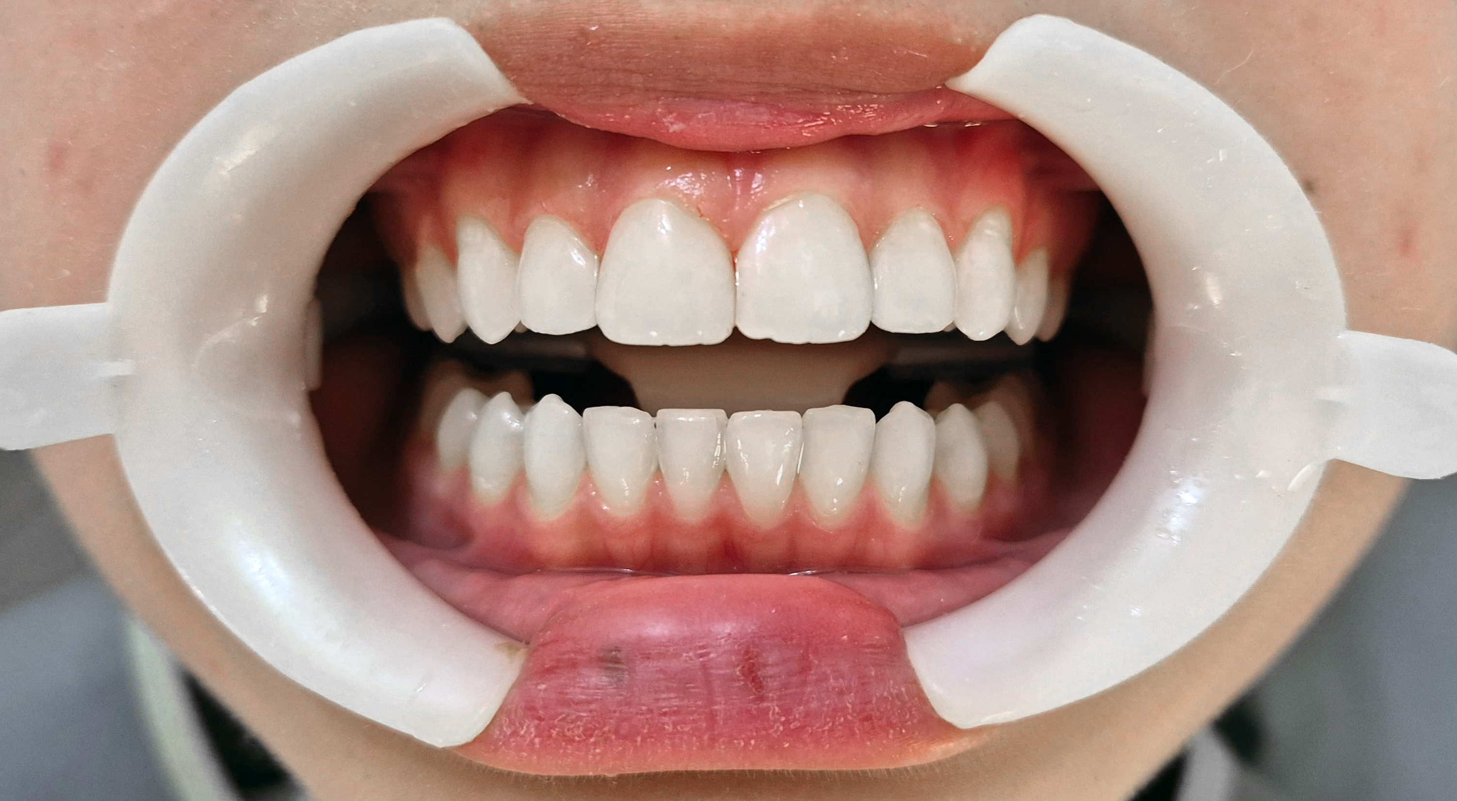 Depois - Facetas e Lentes em resina composta